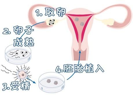ICSI操作